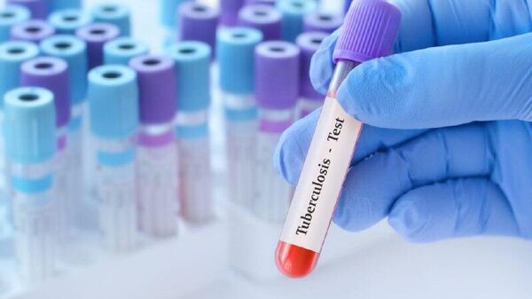 የአፍሪካ የበሽታ መቆጣጠሪያና መከላከል ማዕከል የቲቢ ሕክምናን በአጭር የሞባይል የጽሑፍ መልዕክት ለማሻሻል ያለመ አዲስ ጥናት እያካሄደ እንደሚገኝ አስታወቀ - Sputnik አፍሪካ