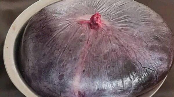 በቀዶ ህክምና 19 ኪሎግራም የማህጸን እጢ ከአንዲት እናት ሆድ ውስጥ ማውጣቱን የወልዲያ አጠቃላይ ሆስፒታል አስታወቀ - Sputnik አፍሪካ