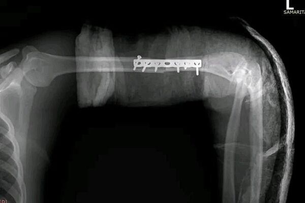 ሳምሪታን ቀዶ ሕክምና ማዕከል ለመጀመሪያ ጊዜ በማሽን የተቆረጠ እጅን በተሳካ ሁኔታ መቀጠል መቻሉን አስታወቀ - Sputnik አፍሪካ