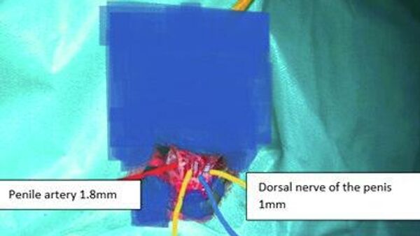 በኢትዮጵያ ለመጀመሪያ ጊዜ ሙሉ በሙሉ የተቆረጠ የብልት ክፍልን በረቀቀ የቀዶ ህክምና በተሳካ ሁኔታ በመቀጠል አዲስ የሕክምና ታሪክ ተመዘገበ - Sputnik አፍሪካ