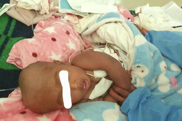 ቅዱስ ጴጥሮስ ሆስፒታል ከውስብስብ የአንጎል አፈጣጠር ችግር ጋር ለተወለደች ሕጻን የተሳካ ቀዶ ሕክምና ማድረጉን አስታወቀ - Sputnik አፍሪካ