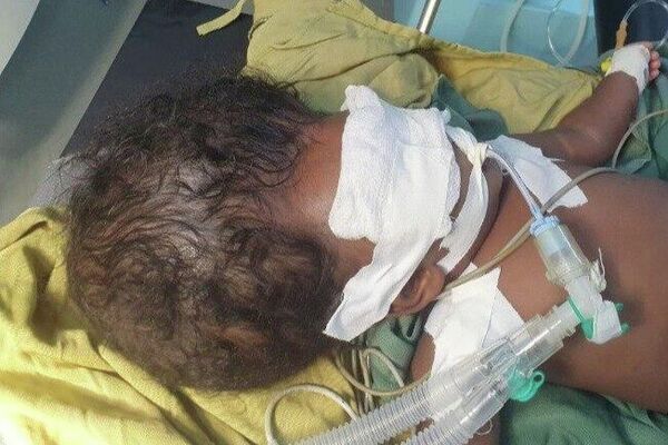 ቅዱስ ጴጥሮስ ሆስፒታል ከውስብስብ የአንጎል አፈጣጠር ችግር ጋር ለተወለደች ሕጻን የተሳካ ቀዶ ሕክምና ማድረጉን አስታወቀ - Sputnik አፍሪካ