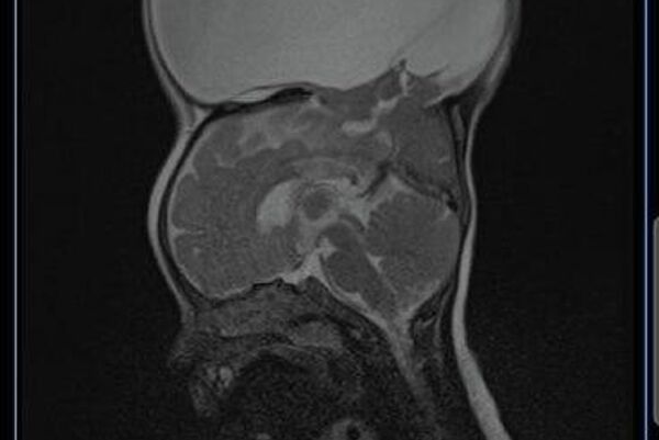 ቅዱስ ጴጥሮስ ሆስፒታል ከውስብስብ የአንጎል አፈጣጠር ችግር ጋር ለተወለደች ሕጻን የተሳካ ቀዶ ሕክምና ማድረጉን አስታወቀ - Sputnik አፍሪካ